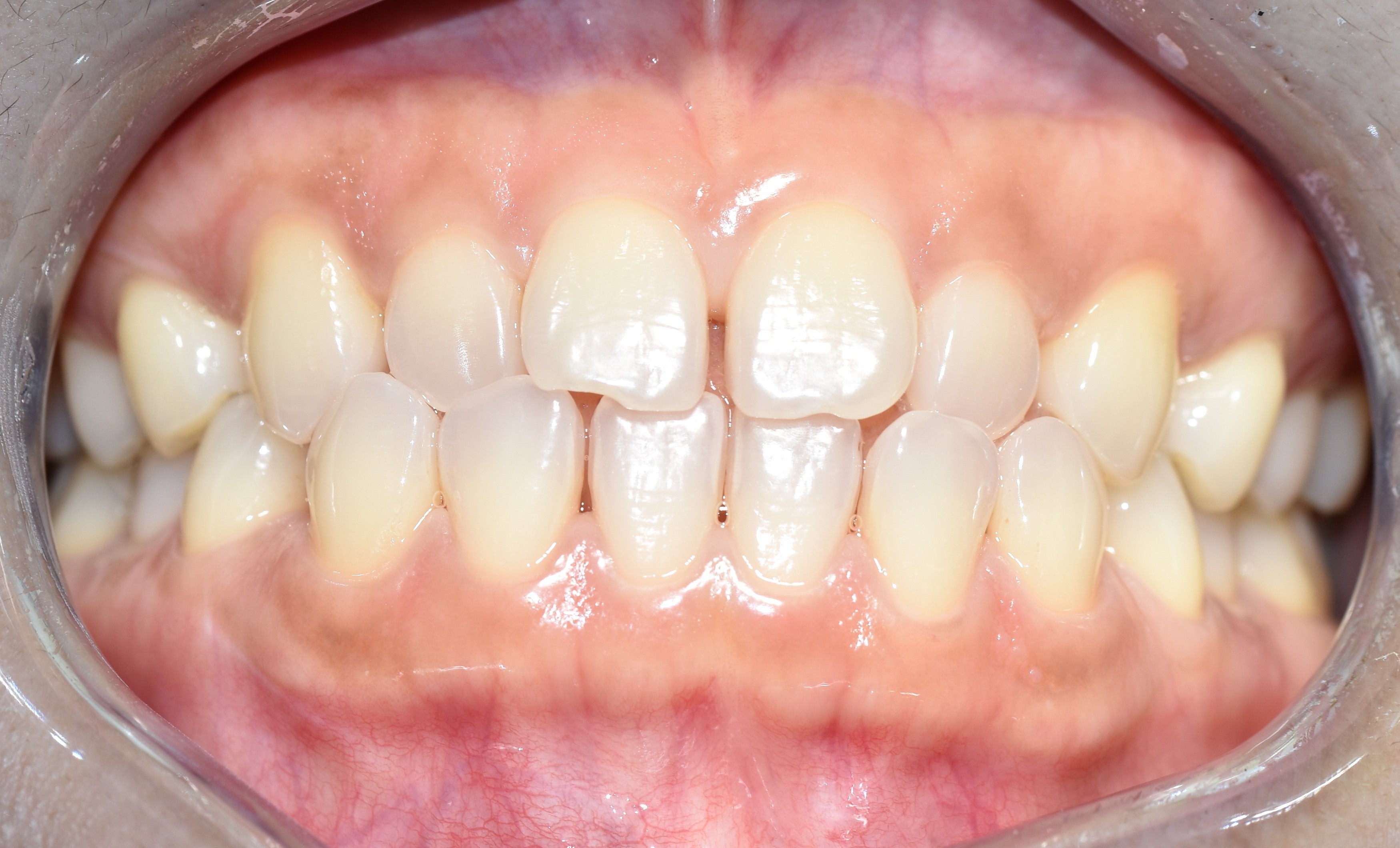 Before treatment